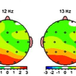 Quantitative electroencephalograms and neuro-optometry: a case study that explores changes in electrophysiology while wearing therapeutic eyeglasses