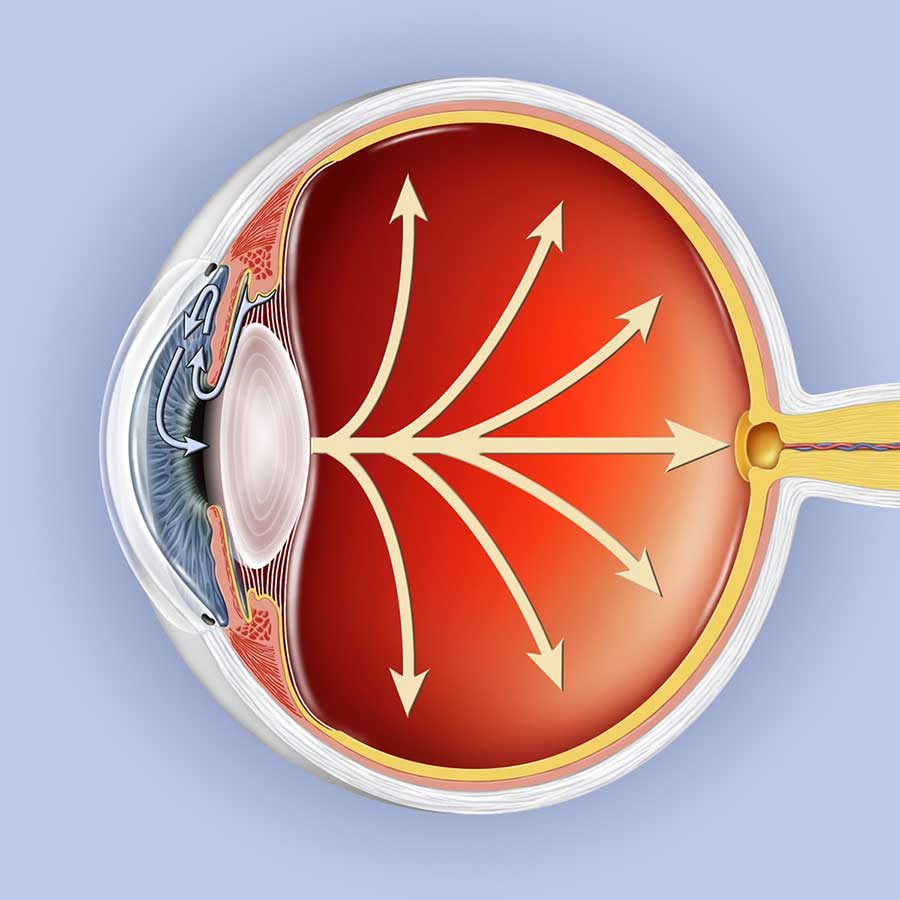 Latest Glaucoma Study Highlights Work of Mind-Eye Team